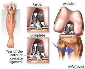 ACL_tear